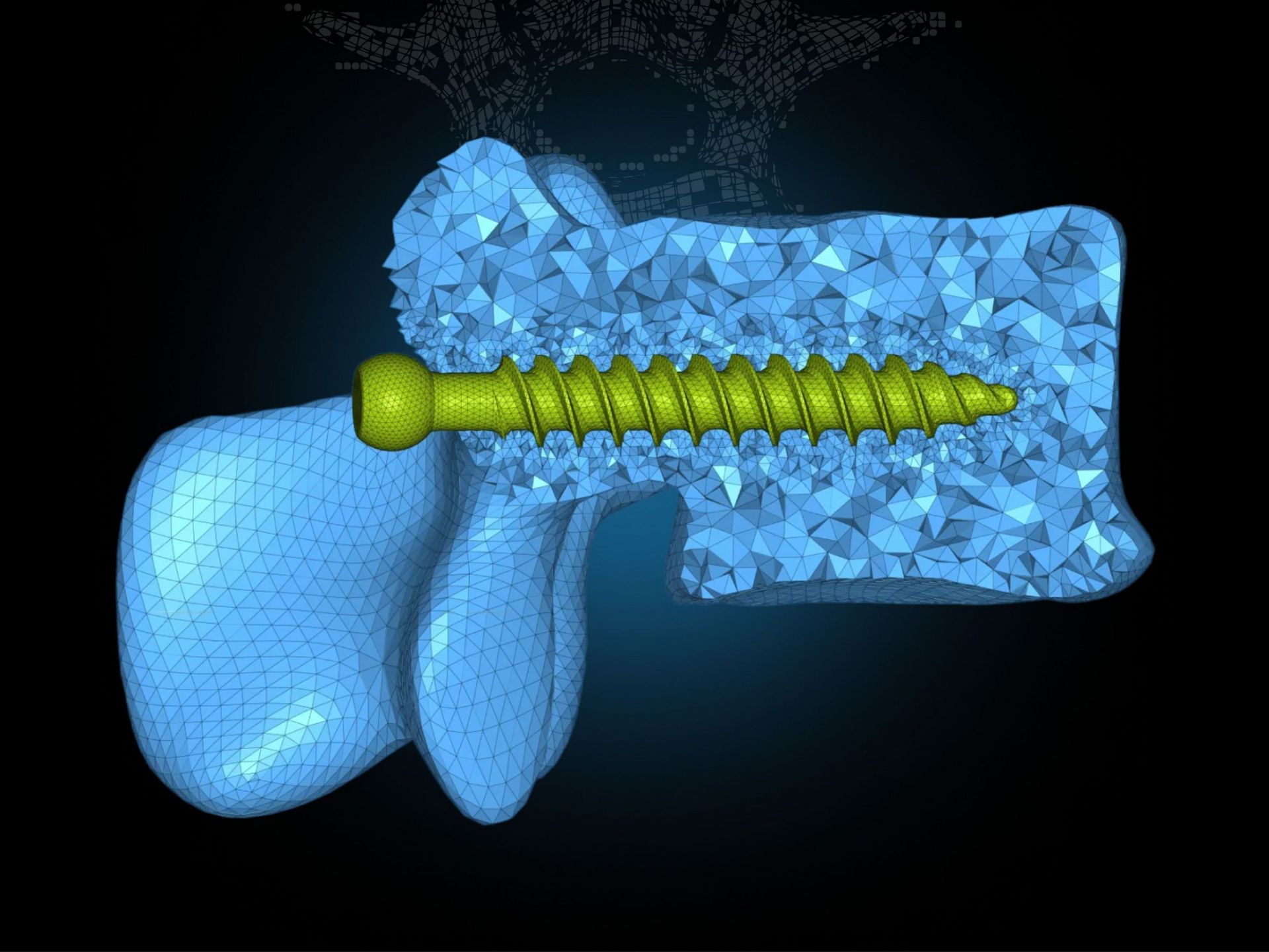 Bei Wirbelsäulenversteifungen setzen Chirurgen meist Pedikelschrauben aus Titan in die Wirbelkörper und verbinden sie mit Metallstäben.
