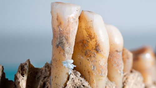 Photo of prehistoric dental plaque.