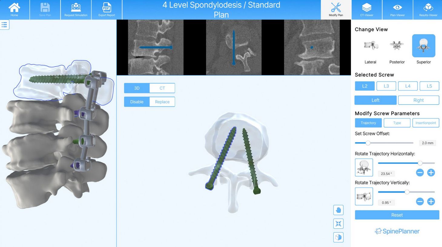 Anhand von CT-Aufnahmen und Angaben des Chirurgen berechnet der SpinePlanner, wo und in welchem Winkel die Pedikelschrauben gesetzt werden müssen, um eine möglichst hohe Stabilität zu erhalten.