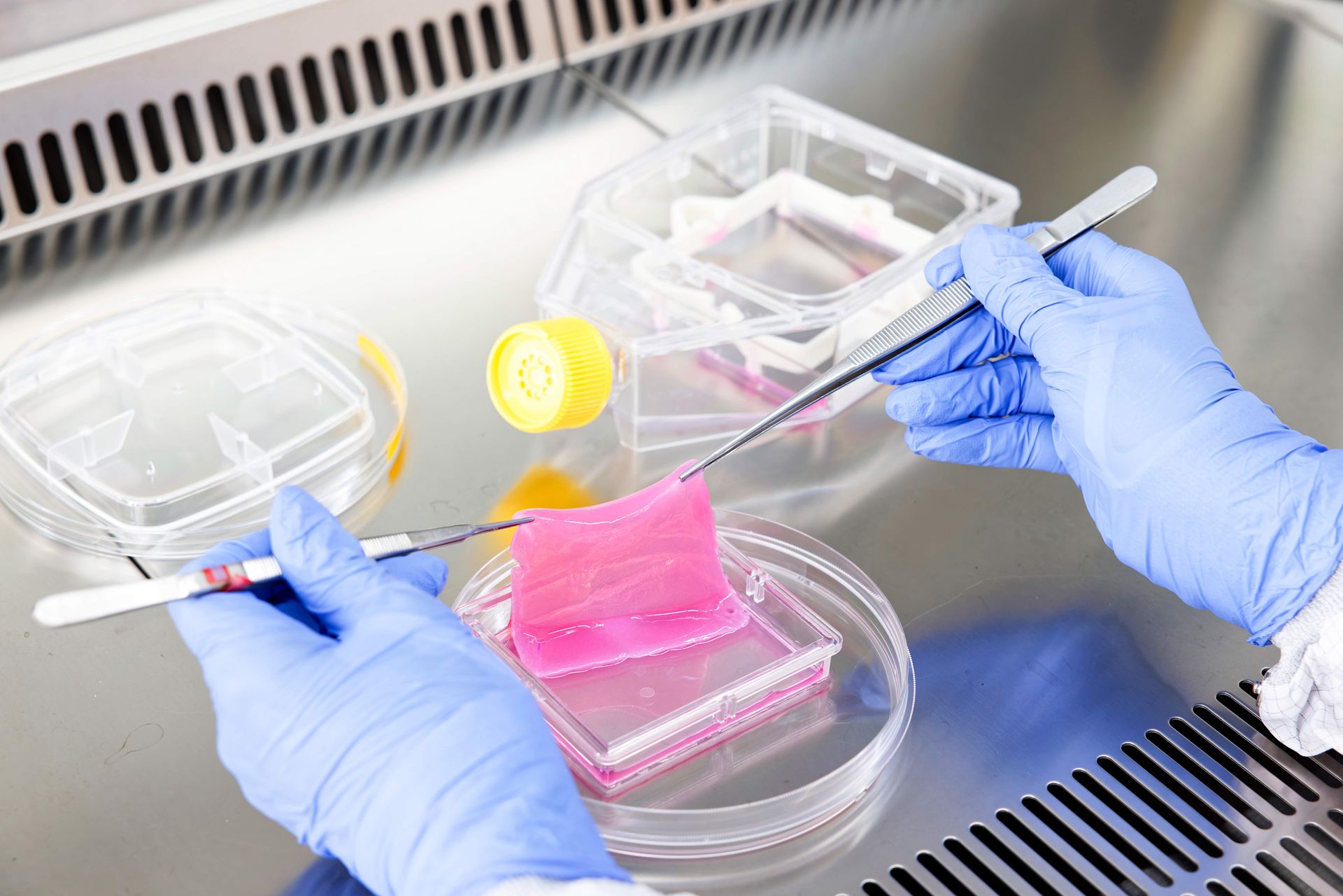 Die am Universitäts-Kinderspital Zürich entwickelte PV-Skin ist der weltweit erste Hautersatz, der vier verschiedene Zelltypen der menschlichen Haut enthält.