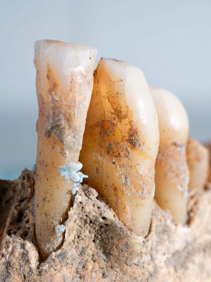 Photo of prehistoric dental plaque.